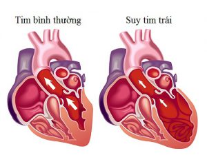 Hình ảnh về suy tim trái